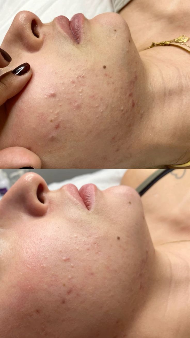 421 Black Peel before treatment